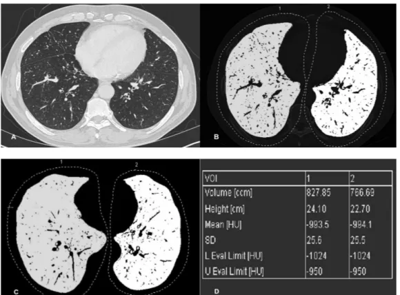 Figure  3.  Lung  volumetric  assessment  methods.  (A)  Axial  CT  image  from  a  57-year-old  man  with  COPD