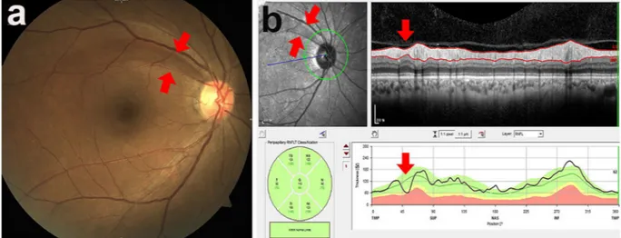 Figure 1.  Localised retinal nerve fibre layer defect assessed using fundus photography (a) and spectral-domain 