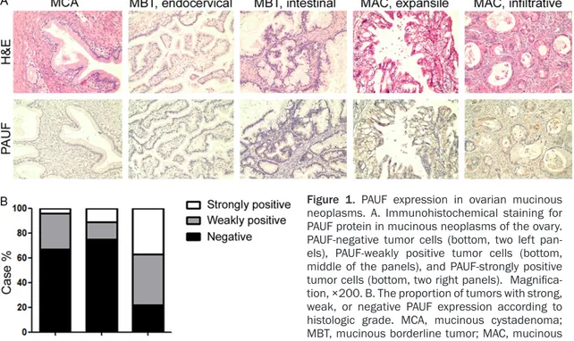 Figure 1. PAUF expression in ovarian mucinous  neoplasms.  A. Immunohistochemical staining for  PAUF protein in mucinous neoplasms of the ovary