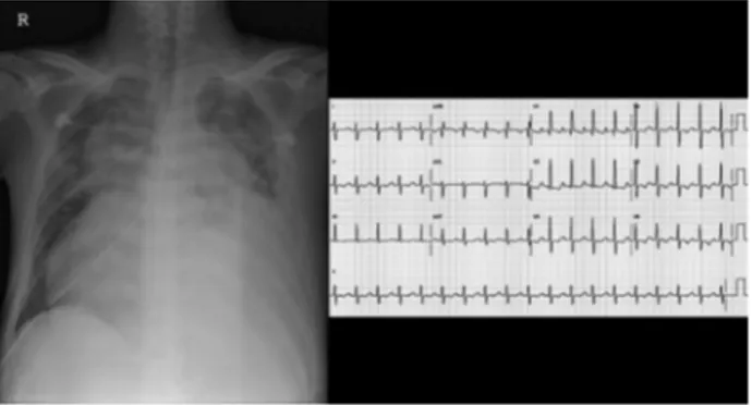 Figure 1. Left, Chest radiograph revealed marked cardiomegaly