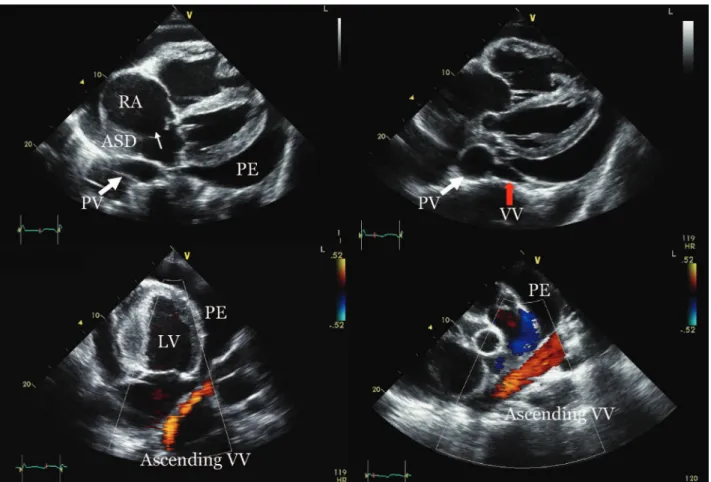 Figure 3. Transthoracic echocardiography revealed a dilated right ventricle and right atrium (RA) and a large amount of pericardial effu-