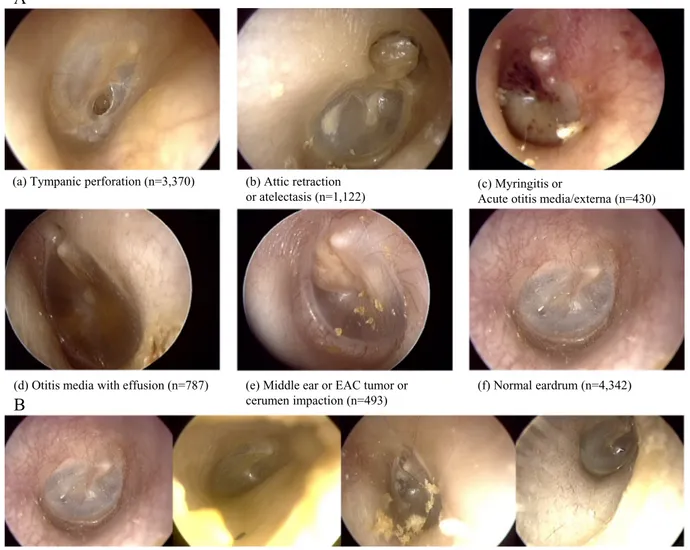 Fig. 2. A) Examples of six classiﬁcations of ear disease, sorted by labelling priority (total n = 10,544)