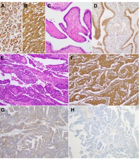 Figure 3.  BTG1 protein expression in non-pathological fallopian tube and ovarian carcinoma tissue 