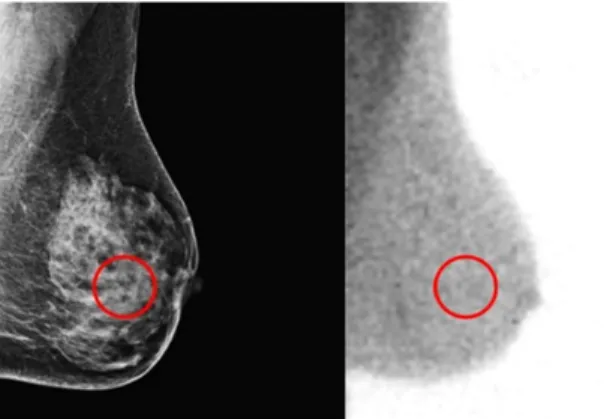 Fig. 2. ROI was drawn in image MBI using image Mammography.