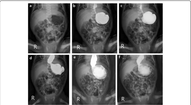Fig. 2 A 3-week-old neonate with gastric volvulus. Images obtained from a 3-week-old neonate who was born at the gestational age of 30 weeks