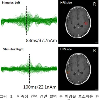 Fig. 2. Results  of  MEG  data  analysis  (waveforms,  isofield  contour  map,  source  localization).