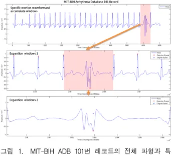 Fig. 1. Specific  portion  of  entire  waveform  and  unusual  waveform  of  MIT-BIH  ADB  101  record.