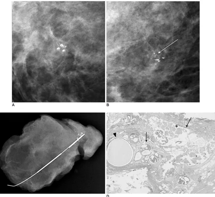 Fig. 1. Carcinoma mixed within milk of calcium of breast in 48-year-old woman.