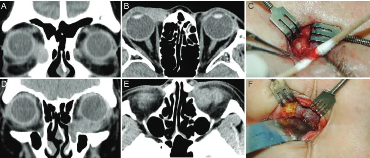 Fig. 1. Computed tomography (CT) scan and operation images of epiphora patients diagnosed with tumor in lacrimal duct (A,B)