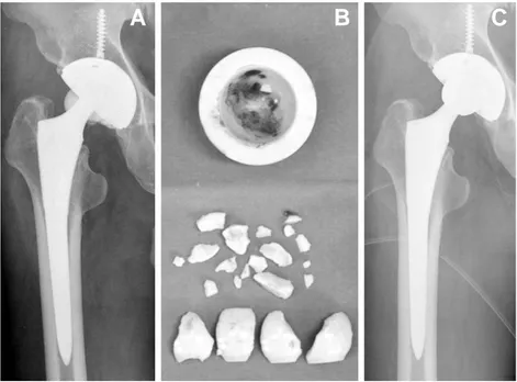 Fig. 2. Sixty-five year old male was performed total hip arthroplasty (A) At 15 months, follow-up radiograph shows the fracture of