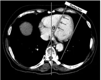 Fig. 1. Method to define the septal angle (θ); angle between the  imaginary midline (line) and the ventricular septum (arrow); 