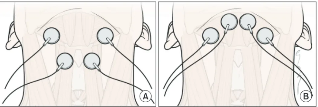 Fig. 1. The electrode positions relative to hyoid bone and thyroid cartilage. (A) Electrodes placement in both submen-