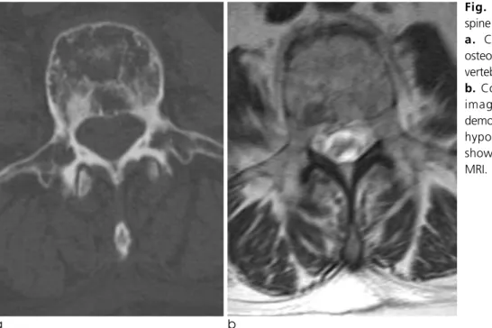Table 3. The Relationship Between Osteolytic or Osteoblastic Characteristics and Signal Intensity on  T2-weighted Images