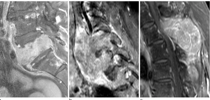 Fig. 7. Mass formation from spinal metastases of three different primary tumors. 