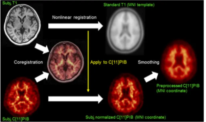 Fig. 1. C[11]-PIB template 제작을 위한 영상프로세싱 과정. 정상인 피 험자의 T1-weighted MRI 영상을 기준으로 C[11]-PIB을 normalized  mutual information을 최소화하는 방법으로 coregistration을 시행하였 다