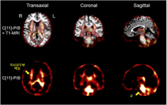 Fig. 5. C[11]-PIB 주성분분석에서 얻어진 두 번째 주성분. 두 번째 주 성분은 측뇌실주변의 백질 그리고 교(Pons) 등을 포함하고 있었다.