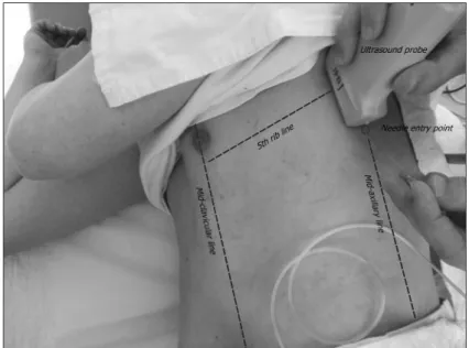 Fig. 1.  Probe was placed over mid-axillary line vertically and needle was introduced  from a caudal to a cephalad direction using in-plane technique.