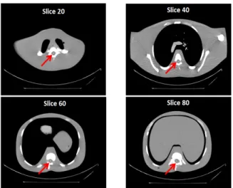 Fig. 5. For evaluate noise and uniformity, cross-sectional views  showing ROI placement in the spine region of the chest phantom