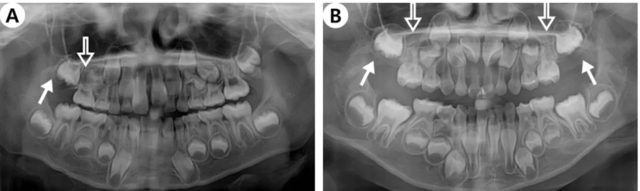 Fig.  1. Panoramic  radiographs  of  patients  with  DFM.  (A)  Unilateral  occurrence  of  DFM  and  congenital  absence  of  adjacent  second  permanent  molar