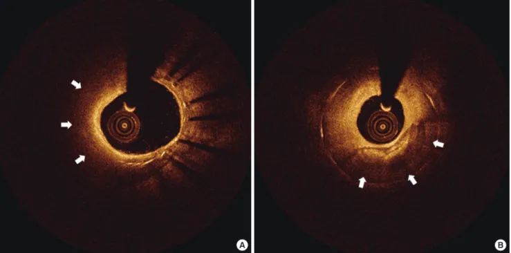 Fig. 1. OCT images of neointima. (A) Lipidic change. (B) Calcific change. Arrows indicate lipid and calcification within neointima, respectively