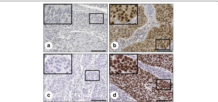 Fig. 1 OCT4 and SOX2 expression in formalin-fixed, paraffin-embedded cervical cancer tissues