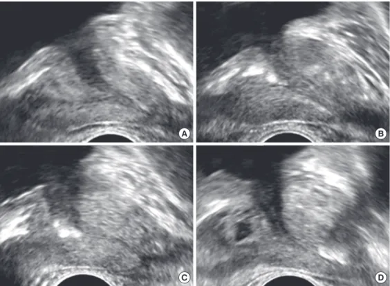Fig. 1.  Representative images of the 3 groups of periurethral calcification (PUC) according to their location on the midsagittal plane  during transrectal ultrasonography