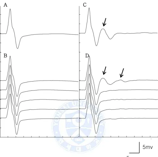 Figure  1. RNS  test  on  ADM  stimulation  by  ulnar  nerve  at  the  elbow.  (A)  R-