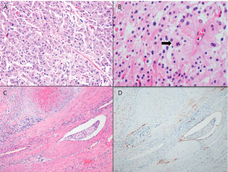 Figure 1. Examples of SDHB-deficient paragangliomas. A, Hematoxylin-eosin–stained slide