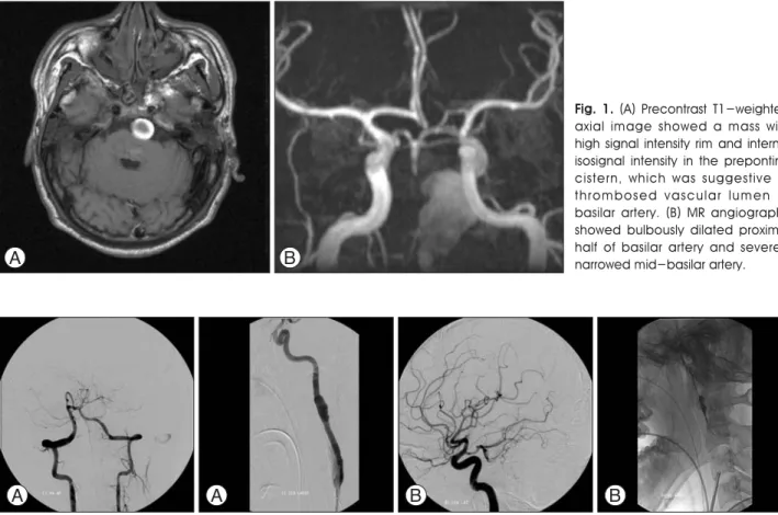 Fig. 2. (A) Vertebral angiogram showed complete occlusion of the basilar artery at just distal to the confluence site