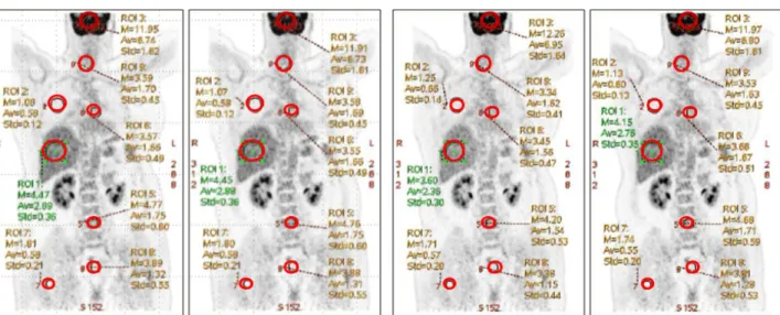 Fig. 4. PET/CT scans according to low dose protocol and standard dose protocol. Relative error and signal to noise ratio of SUV were  analyzed.