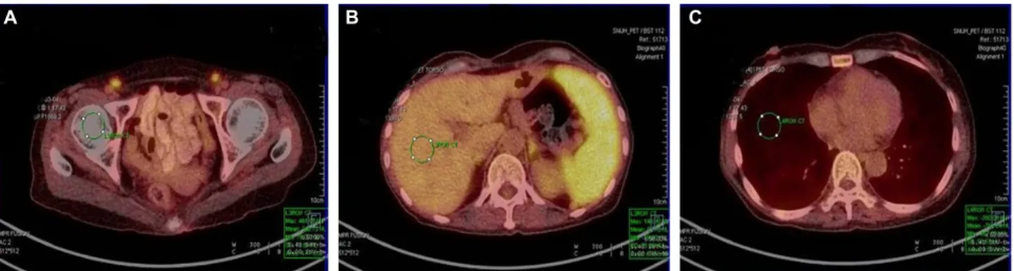Fig. 3. (A, B, C) Each ROI is set 4.5 cm 2  in bone, liver, lung and recorded maximum and mean SUV