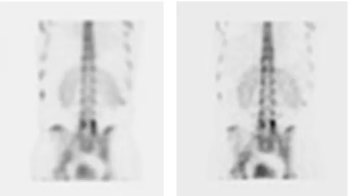 Fig. 7.  131 I Chest SPECT/CT (Non AC &amp; AC).