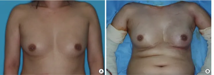 Figure 2.  Representative reconstructive outcome: a 40-year-old woman with mucinous carcinoma of left breast