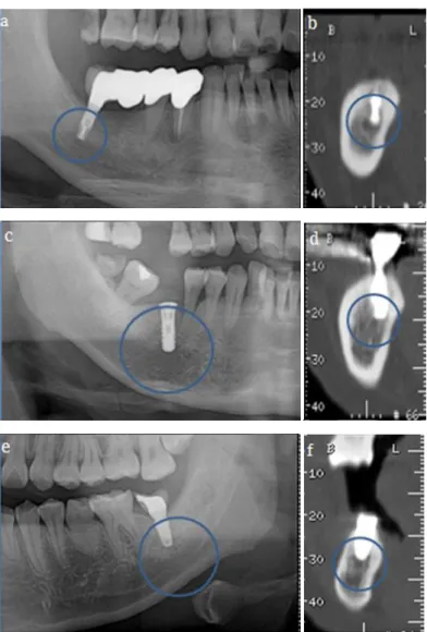 Figure 3. Variable imaging evidence between panoramic and CT radiography on the same patient