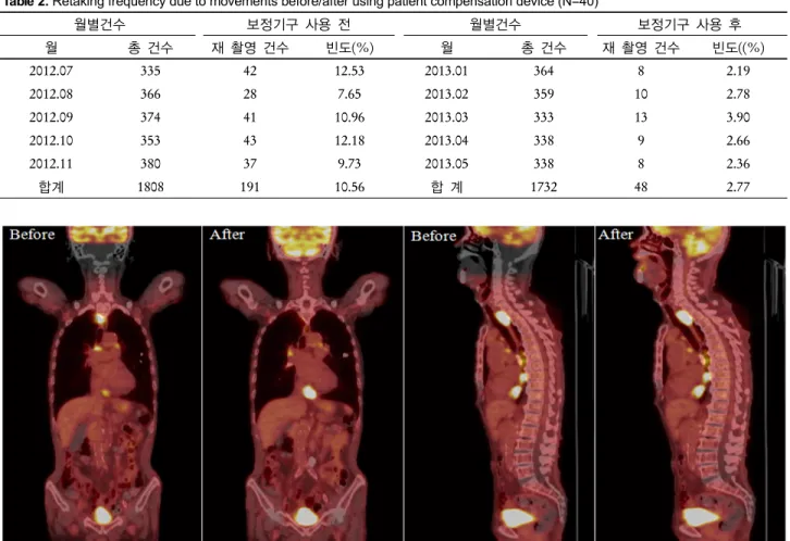 Table 2. Retaking frequency due to movements before/after using patient compensation device (N=40) 월별건수 보정기구 사용 전 월별건수 보정기구 사용 후 월 총 건수 재 촬영 건수 빈도(%) 월 총 건수 재 촬영 건수 빈도((%) 2012.07 335 42 12.53 2013.01 364 8 2.19 2012.08 366 28 7.65 2013.02 359 10 2.78 2012