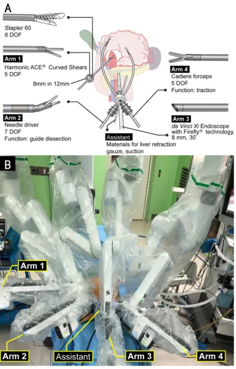 Figure 2.  Reduced-port robotic gastrectomy. (A) Schematic illustration of reduced-port robotic distal 