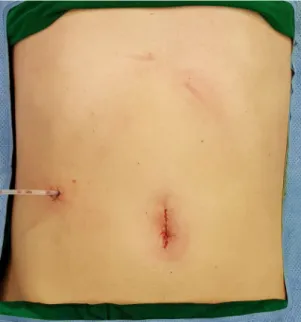 Figure 4.  Surgical wound. A drain is inserted via right trocar site. Umbilicus was closed with subcuticular 