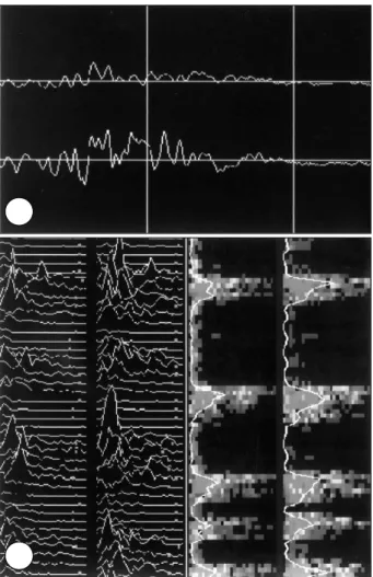 Fig. 3. A：Two channels of digitalized EEG(upper F3-P3, lower 