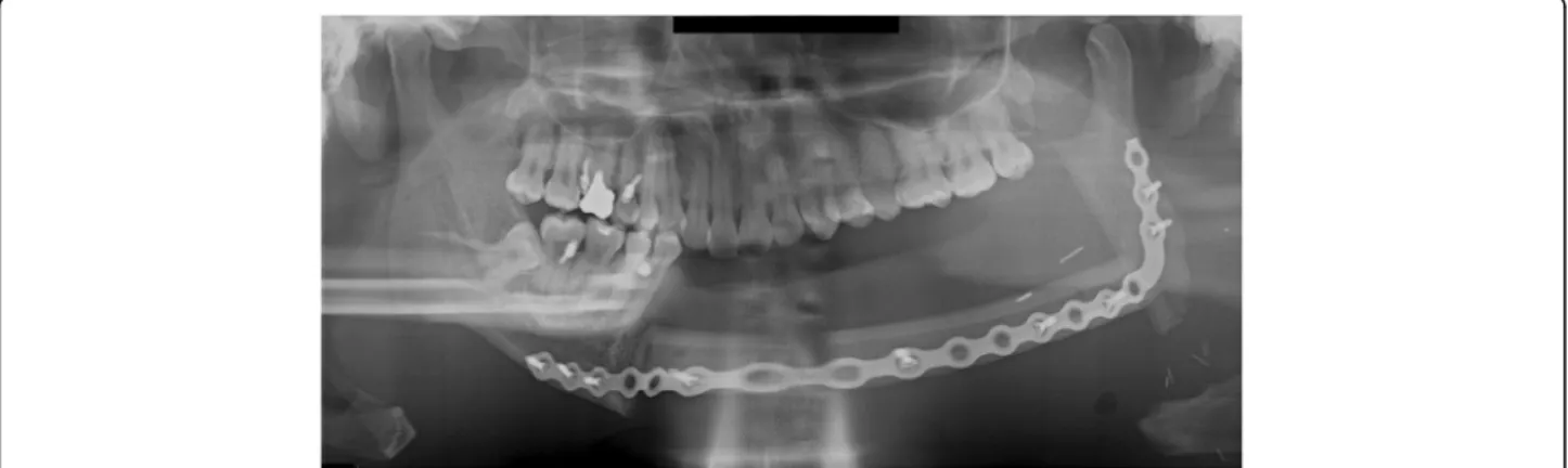Fig. 1 A panoramic radiograph obtained immediately after reconstruction using FFF following left mandibular resection