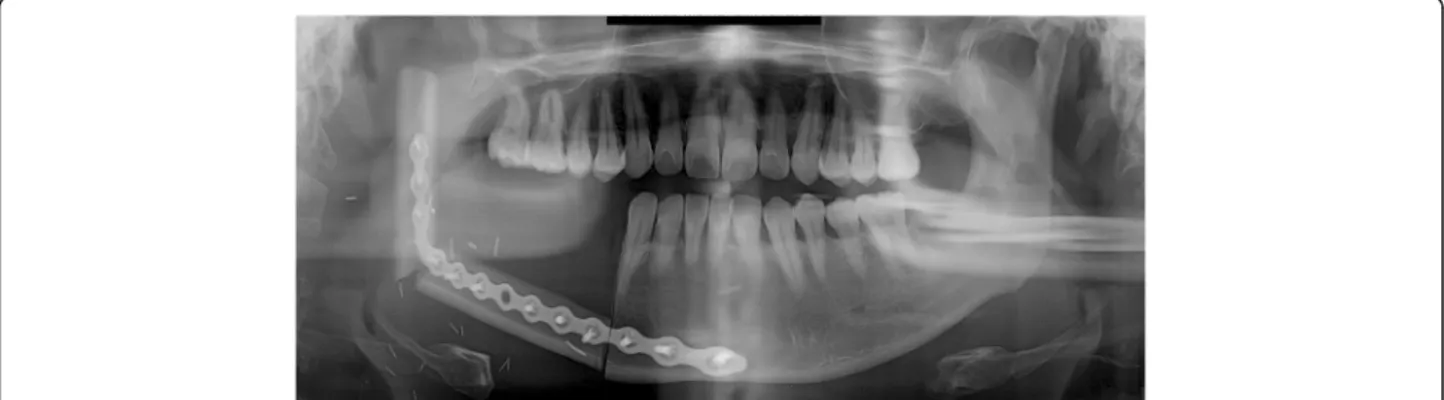 Fig. 3 A panoramic radiograph obtained immediately after reconstruction using FFF following right mandibular resection