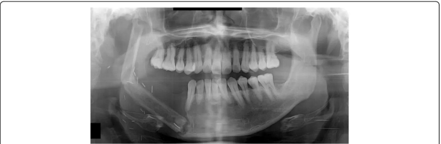Fig. 4 A panoramic radiograph obtained 2 years and 1 month after reconstruction using FFF following right mandibular resection