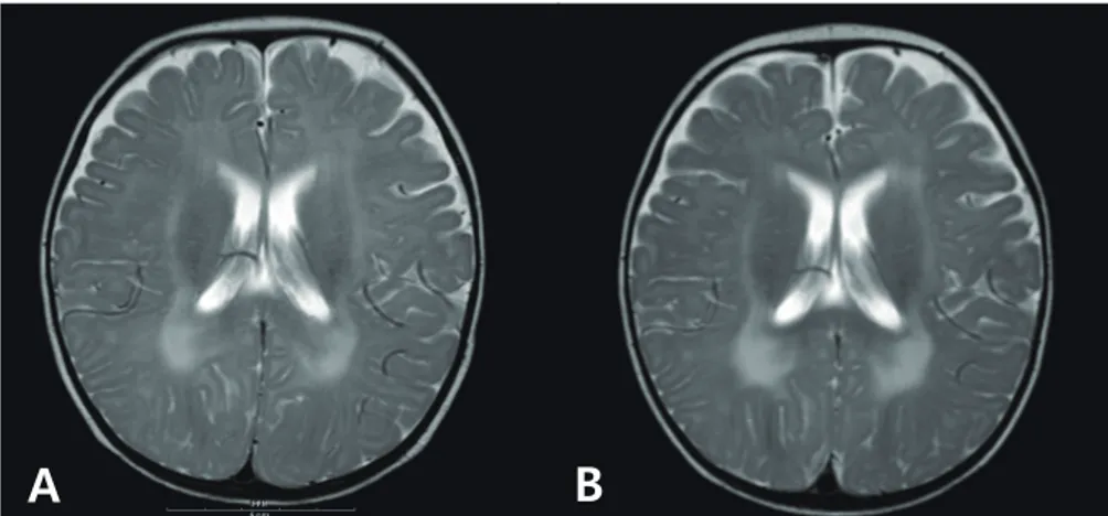Fig. 1.  Axial T2-weighted brain magnetic resonance images of the patient at 6 months of age shows  high signal intensity in the white matter of the peritrigone and external capsule (A); slight progression of  dysmyelination can be seen 2 months later (B).