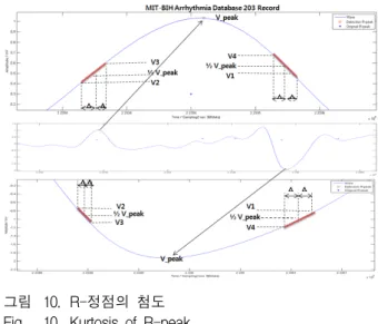 Fig. 9. Example  of  adaptive  refractory  period  of  MIT-BIH  R-wave.