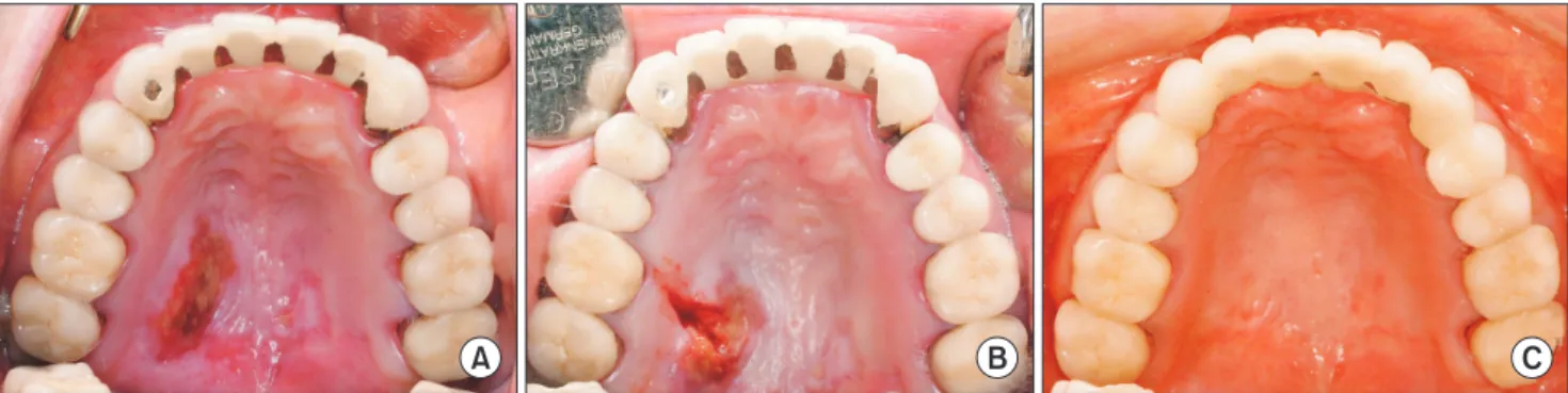 Fig. 2. A. Recurrent lesion on the right hard palate five months after the initial visit