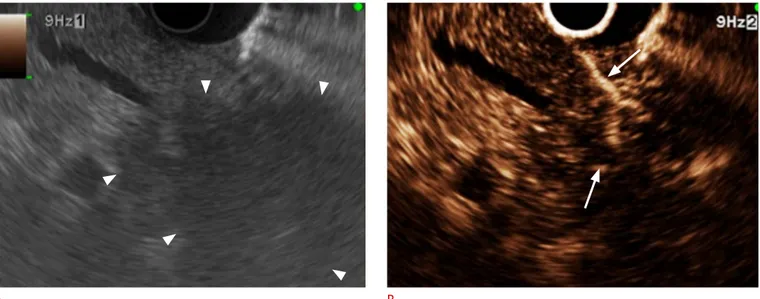 Fig. 1.  Typical contrast-enhanced harmonic endoscopic ultrasonography (EUS) image of pancreatic carcinoma.
