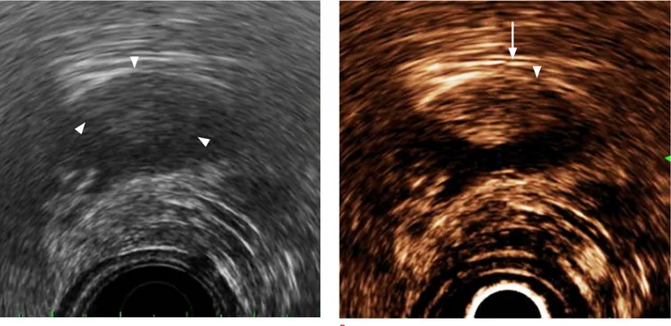 Fig. 3.  Application of contrast-enhanced harmonic endoscopic ultrasonography (EUS) in the staging of gallbladder cancer.