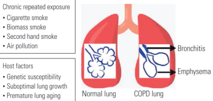 Fig. 1.  Causes and risk factors for COPD. Besides exposure to noxious  particles or gases, host factors determine the susceptibility of  individu-als to develop COPD