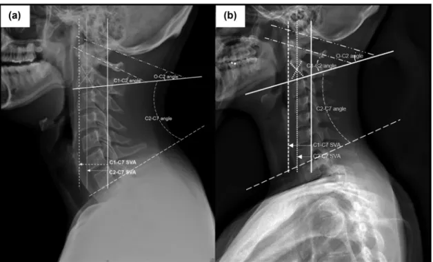 Figure 1: Parameters of sagittal cervical alignment on plain radiographs. (a) The lordotic group: O–C2 angle, angle between the McGregor line and the lower endplate of C2; C1 –C2 angle, angle between a line connecting the anterior tubercle to the posterior