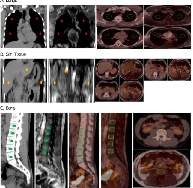 Fig. 5. After we displayed PET emission images reconstructed using 2 different attenuation maps of CT and MR, we  evaluated SUVs (standard uptake values) for same location