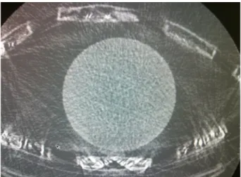 Fig. 7. The artifacts from metals were observed in MR Torso Coil.